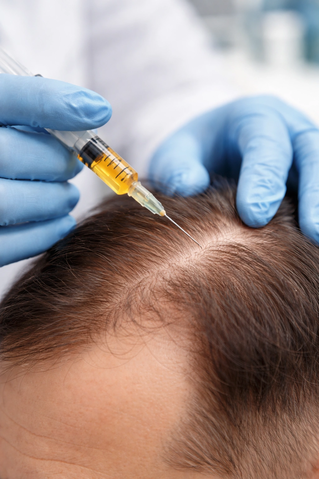 Clinician injecting scalp with PRP during advanced treatment
